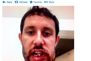 A Stick To The Face Turned Edmonton Oiler Sam Gagner Into A Monster