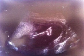 UK's youngest heart op baby