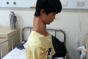 Chinese Teenager With Unusually Long Neck