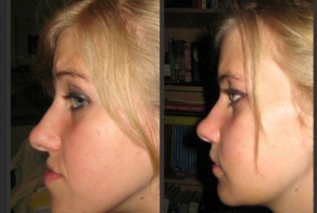 Life Changing Jaw Surgery