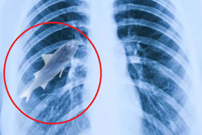 12 Horrifying Things Found Living Inside A Human Body