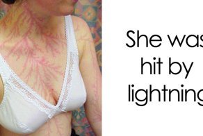 19 People Who Survived Getting Struck By Lightning Show What It Does To Your Skin