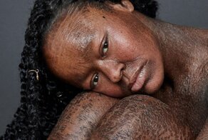 This Woman Never Saw Models With Her Skin Condition, So She Became One