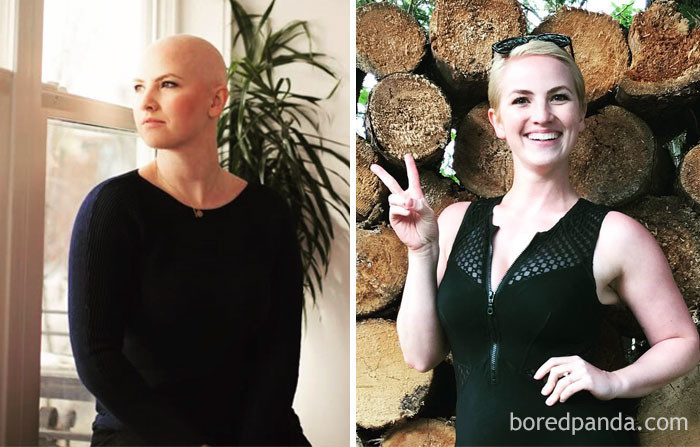 Люди, победившие рак: поразительные фото до и после