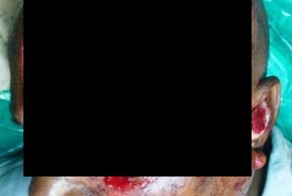 Пересадка кожи бедра на лицо (5 фото)