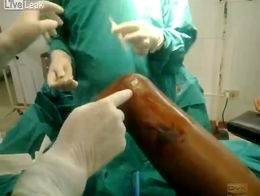 Лечение диабетической ноги с гноем и гангреной.