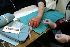 Обмороженные пальцы