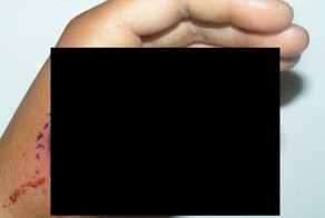 Последствия укуса змеи в палец (6 фото)