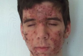 За полтора года избавился от прыщей (9 фото)