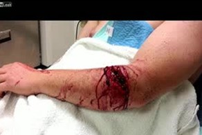 Глубокая рана от бензопилы на руке