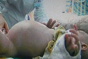 Двухлетний мальчик родил своего близнеца