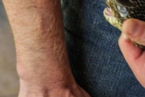 Американец выжил после сотни укусов ядовитых змей