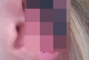 Итальянский паучок оставил девушку без уха