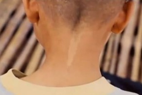 Родимые пятна как свидетельство о переселении душ