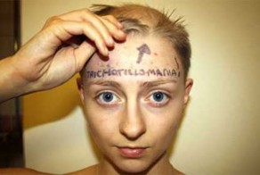 Девушка пять лет вырывала на голове волосы, пока не облысела