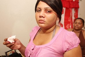 Девушка плачет кровавыми слезами и потеет кровью из-за редкого заболевания