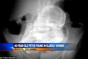 Медики обнаружили у 82-летней колумбийки закостеневший эмбрион