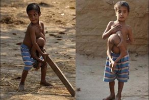 Люди, родившиеся с лишними частями тела