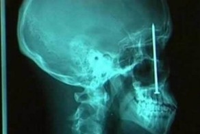 Рентгеновский снимок, который шокируют Вас