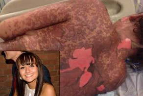 Таблетки от изжоги расплавили 17-летнюю девушку