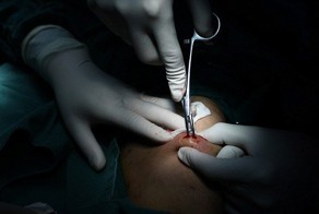 Нетрадиционное китайское лечение зашитыми под кожу жемчужинами