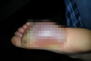 На ноге лопнул блистер после обморожения