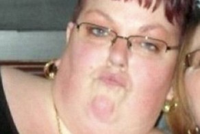 Куда девается лишняя кожа после значительного сброса веса