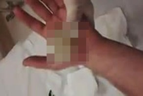 Ожог ладони 2-ой степени