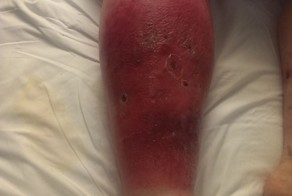 Ужасные последствия укуса кота за ногу