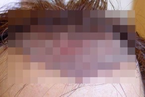 Голова человека после операции по пересадке волос