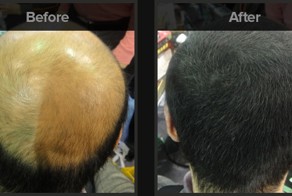 Отличная альтернатива трансплантации волос