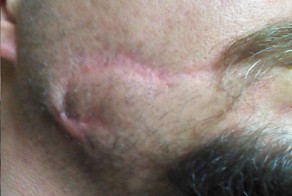 В пьяной драке получил розочкой по лицу