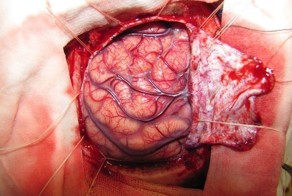 Эпилепсия лечится (3 фото)