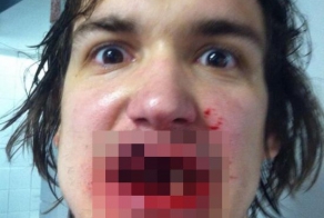 Прямое попадание хоккейной шайбы в лицо