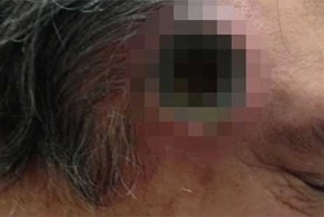 Мазь для кожи пробурила в голове у мужчины дыру