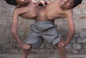 Сиамские близнецы в Индии стали новым божеством