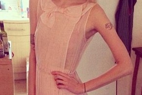 9 знаменитых женщин, умерших от анорексии