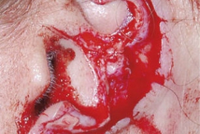 Как с помощью пиявок отремонтировать оторванное ухо