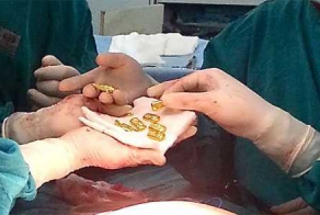 Хирурги нашли в животе бизнесмена клад