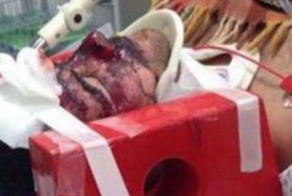 Велосипедист наехал на ямку и раскроил вебе пол лица