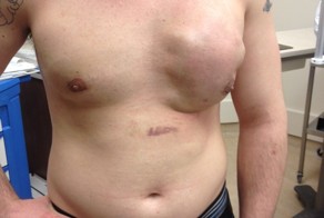 Чихнул через пару недель после гинекомастии