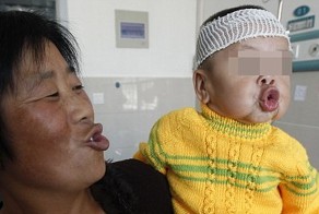 Редчайшее генетическое заболевание китайской малышки