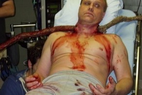 Обломок ветки попал мужчине в шею