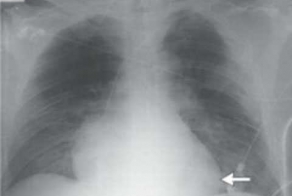 Мотоциклист без сердца шокировал врачей