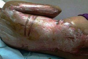 Горничную облили кипятком из-за чрезмерной медлительности