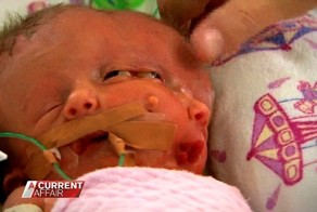 Сиамские близнецы с мозгом в двух экземплярах