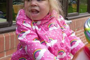 Врачи отрезали девочке огромный язык