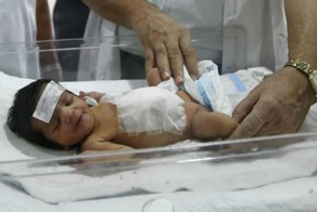 Хирурги ампутировали выросшую на животе новорожденного голову