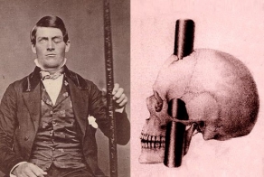 Финеас Гейдж, человек потерявший часть мозга