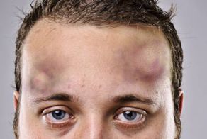 "Шел. Упал. Опух. Умер"